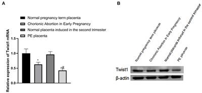 The Mechanism of Downregulation of Twist1 Inhibiting Trophoblast Invasion and Aggravating the Development of Preeclampsia